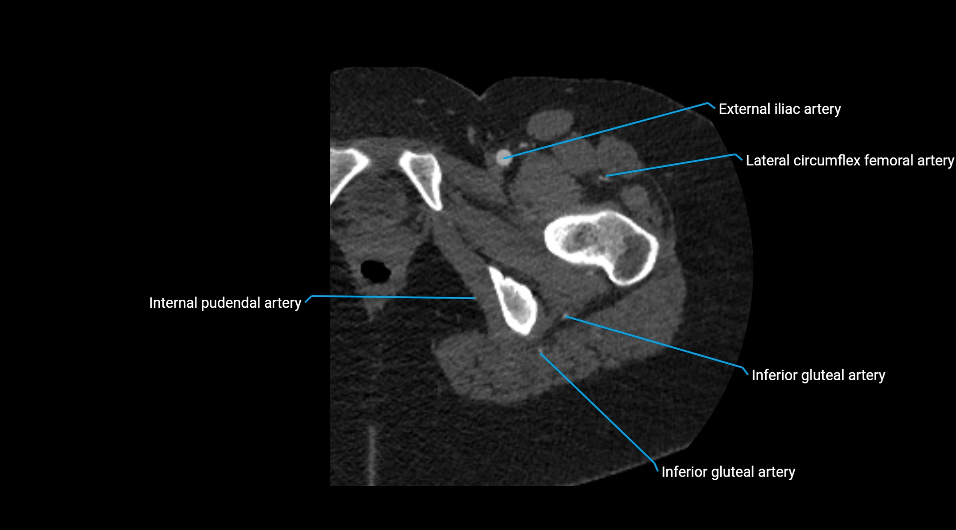CTA lower limb cross sectional anatomy labelled image _64.webp
